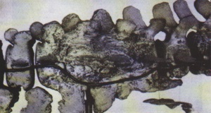 格陵兰露脊鲸的骨骼（病态）